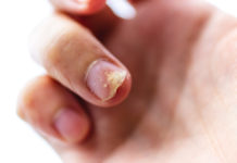 Does coconut help psoriasis? Does coconut help psoriasis?