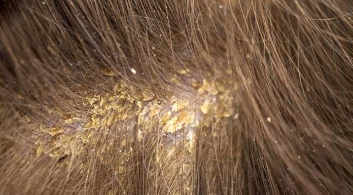 How do you detox your scalp? How do you detox your scalp?