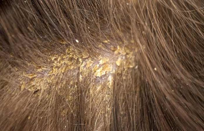 How do you detox your scalp?